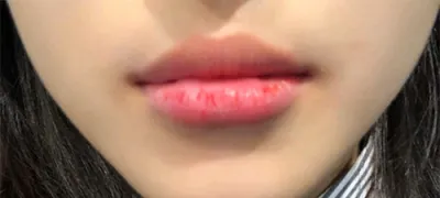 [プチ] イイddd - 唇フィラー