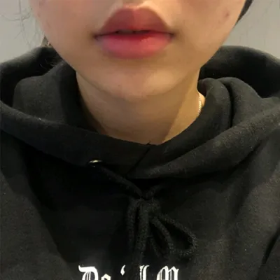 [プチ] めんどくさいw - 唇フィラー