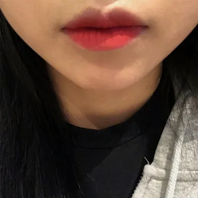 [プチ] イ1プデュ - 口角フィラー、ボトックス