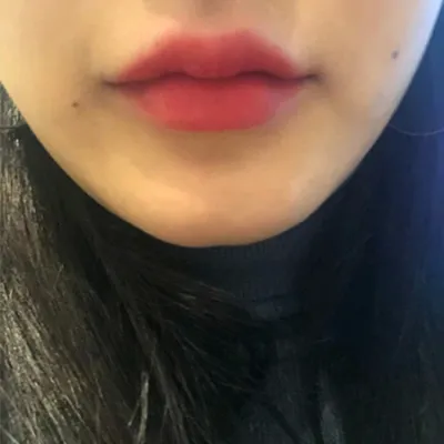 [プチ] hjhsjs - 顎ボトックス、フィラー