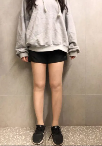 [脂肪吸引]キャーキャー - 脂肪吸引