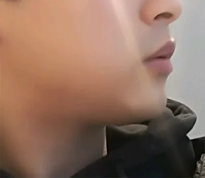 [皮膚]キャルルク - シュリンク、輪郭トックス