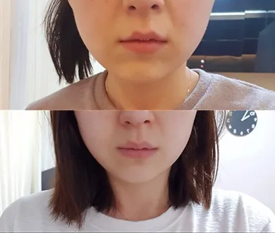 [쁘띠] deinmm - シュリンク、輪郭ボトックス