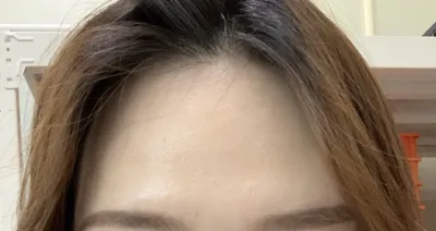 [アンチエイジング] 私です~~ - 額の脂肪移植