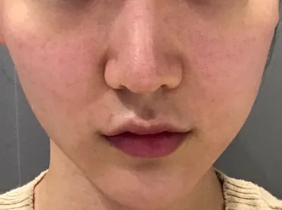 [皮膚] nomango - 毛穴