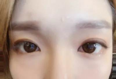 [目] 整形レビュー - 目