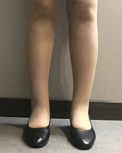 [脂肪吸引] 星のように舞い上がれ - ふくらはぎ