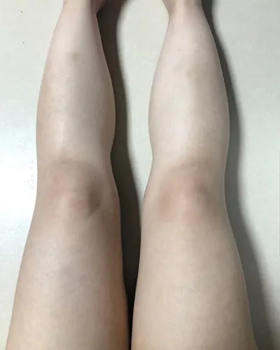 [脂肪吸引] zz0808 - ふくらはぎ、太ももの脂肪吸引