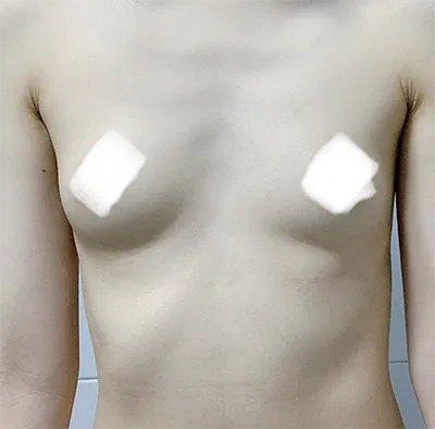 [豊胸] イロコイ - 胸