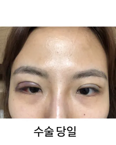 [目] スリ8536 - 目つき矯正