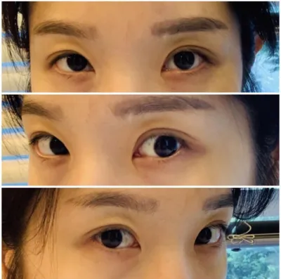 [目] タタンブリ - 目頭切開、目尻切開