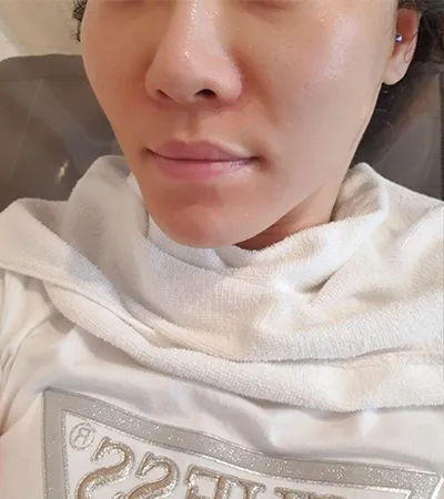 [皮膚] ボンベリ - エアーシュリンク