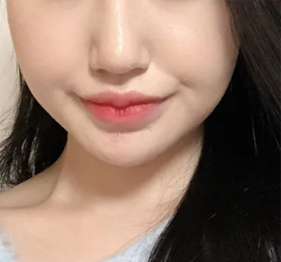 [皮膚] ジジジジジジ - シュリンク、輪郭ボトックス