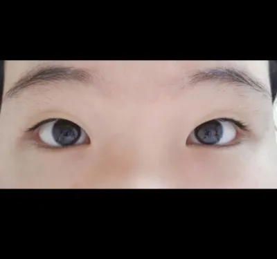 [目] ソ・ユユン - 埋没法、目頭切開