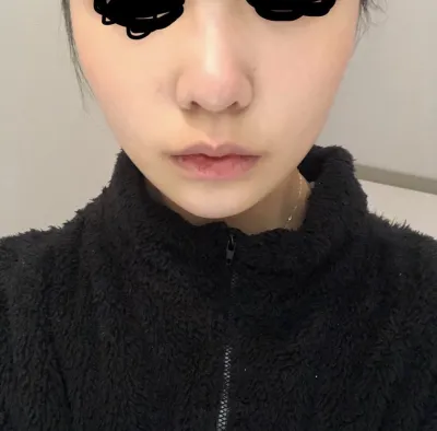 [鼻] mm9 - 小鼻縮小