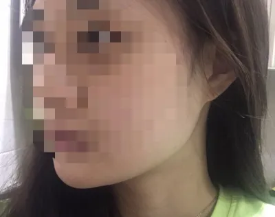 [プチ] ニナナニアンイ - 脂肪溶解注射、リフティング