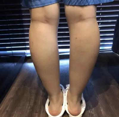 [プチ] ピョングン - ボトックス、脂肪溶解注射