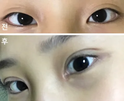 [目] solmdd - 目頭切開、眼瞼下垂手術