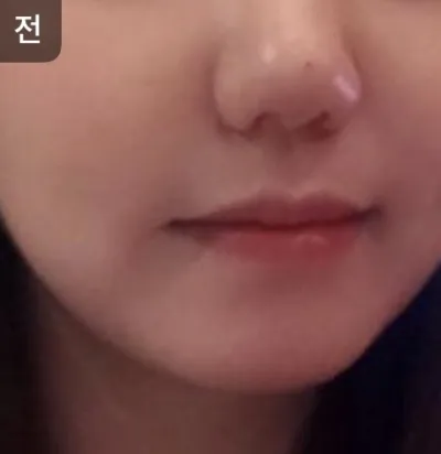 [皮膚] oy1004 - リフティング、水光注射