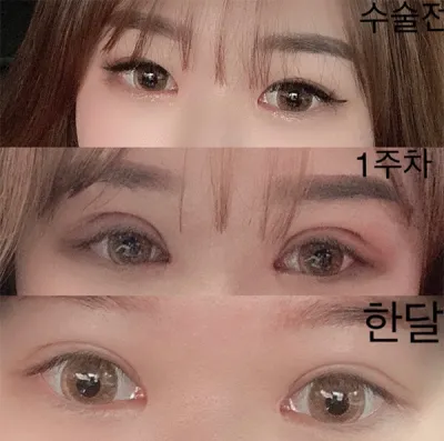 [目] ロシオン - 目頭切開（上眼瞼切開）、眼瞼下垂手術、再手術