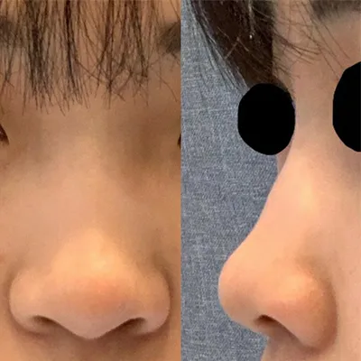 [鼻] キュンキュンコン - 鼻