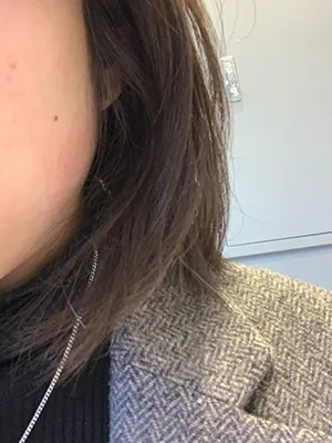 [プチ] メランコリーな季節 - 顎ボトックス