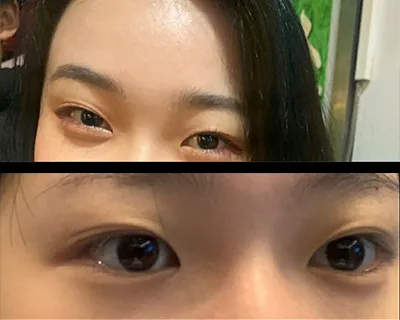 [目] 知恵1 - 埋没法、目つき矯正