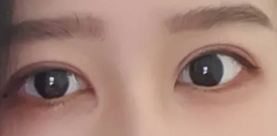 [目] ムリン - 目頭切開、目の再手術