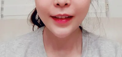 [皮膚] gus0311 - フィラー、リフティング