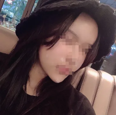 [アンチエイジング] カンナムチョア - 脂肪移植