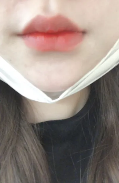 [プチ] リリゴル - 唇フィラー