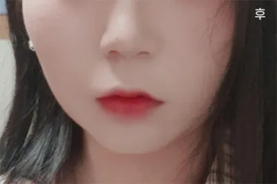 [アンチエイジング] alss12 - 顔の脂肪吸引