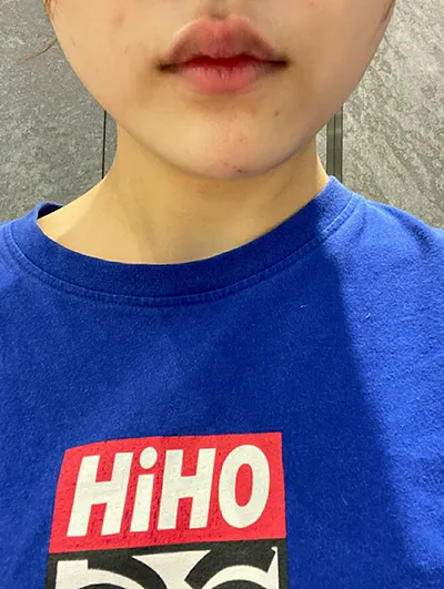 [プチ] ジユンス - エラ ボトックス