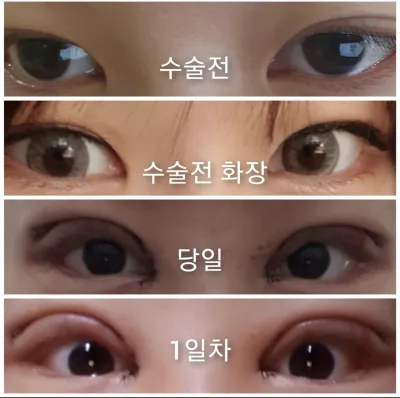 [目] コギヨン - 二重まぶた、目頭切開、目尻切開