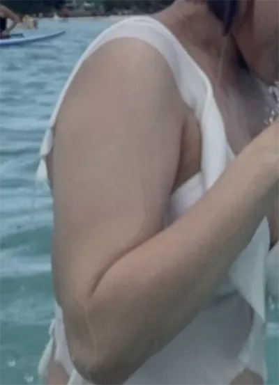 [脂肪吸引] ソ・イェ - 腕