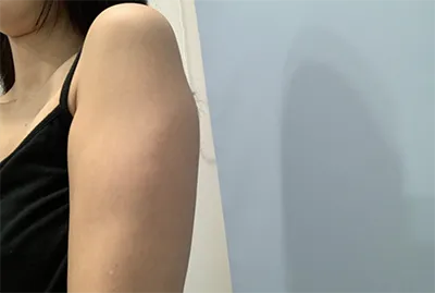 [脂肪吸引] クラルリル - 腕、副乳の脂肪吸引