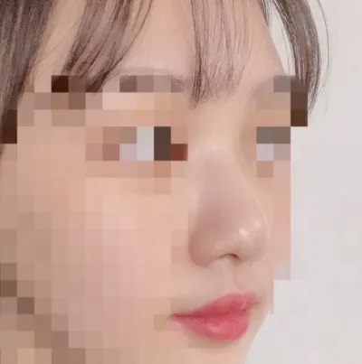 [鼻] ロンダランサ - 鼻整形