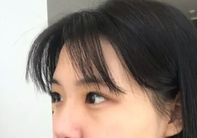 [目]ウンアンウン - 二重(自然癒着)、目頭切開