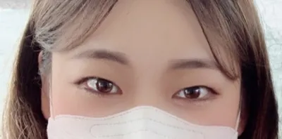 [目] ダロム - 二重切開、目つき矯正