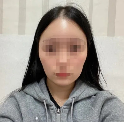 [輪郭手術] レモン55 - エラ削り、顎先縮小