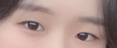 [目] 0202u - 目頭切開、二重