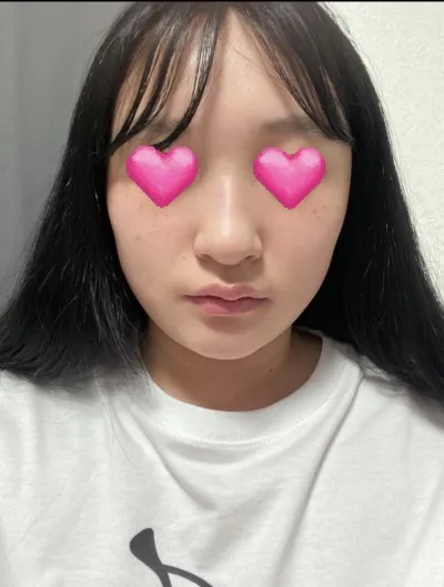 [鼻]ミンカイン - 鼻