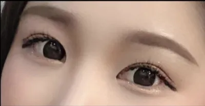 [目] sidhd22 - 目尻切開、グラマラスライン形成