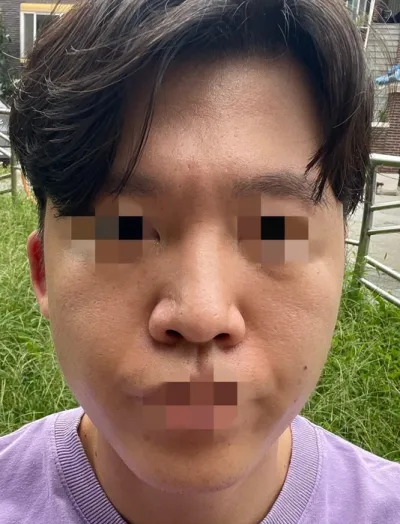 [男性] ジョアン - 鼻、輪郭