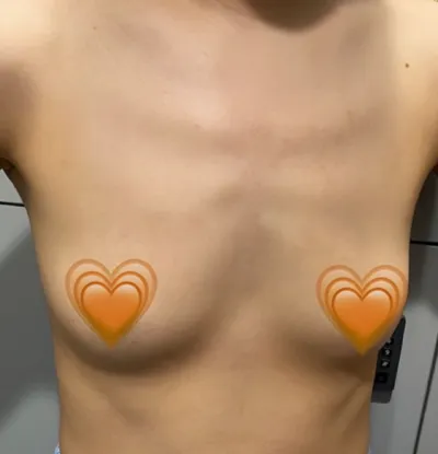 [豊胸] 弾むようなバスト