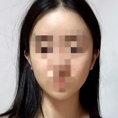 [輪郭手術] ミンブリー - 顔面輪郭