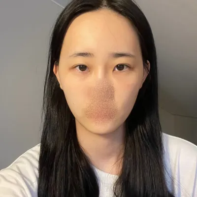 [目] 三三五五有 - 目、脂肪移植、輪郭