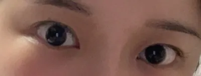 [目] スーピアン - 目、脂肪移植