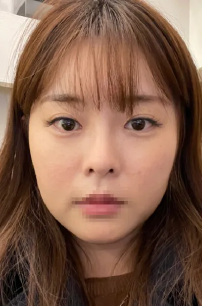 [輪郭手術] 合井カフェ - 目、鼻、顔の脂肪吸引、輪郭