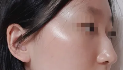 [鼻]ピノキオ - 鼻